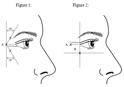 Botox Facial Diagram Wiring Schematic Diagram 6 Laiser