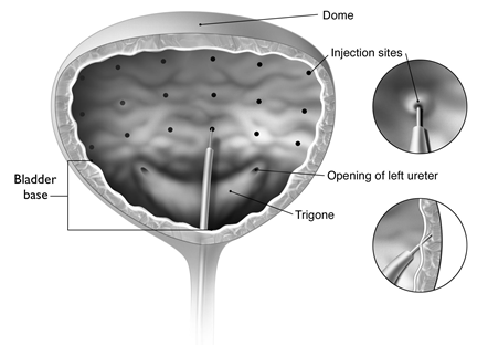 BOTOX 100 Units - Summary of Product Characteristics (SmPC) - print ...