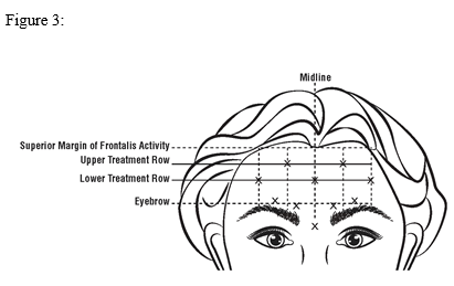 Botox 200 Units - Summary of Product Characteristics (SmPC) - (emc)